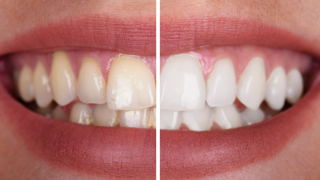 teeth whitening in nw calgary