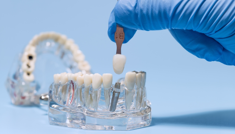 what are the components of a dental implant restoration