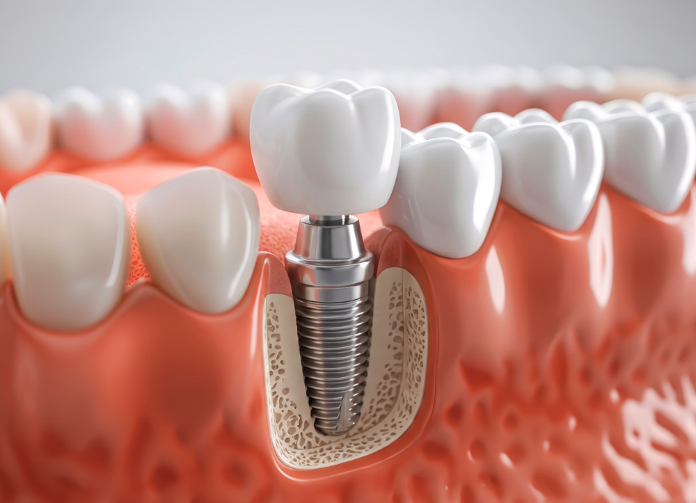 The Role of Technology in Dental Implant Surgery
