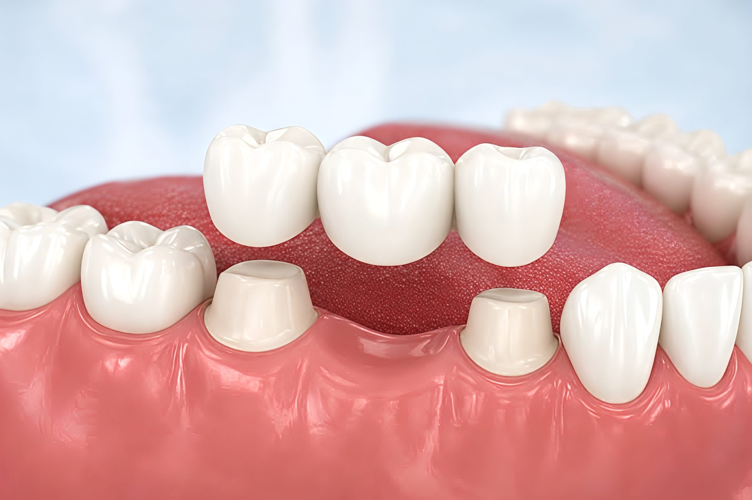 How Do Dental Bridges Replace Missing Teeth?